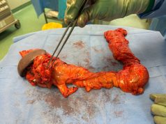 مدينة الملك عبدالله الطبية تنجح في استئصال ورم متقدم متعدد ممتد لمريض سبعيني في عملية جراحية معقدة