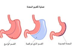 استشارية تجيب أيهما أفضل لمواجهة ” السمنة المفرطة ” ربط المعدة أم التكميم ؟
