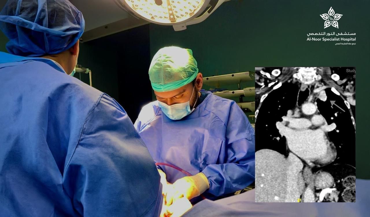 إستئصال ناجح لانتشار ورمي في الرئة اليسرى باستخدام المنظار الجراحي أحادي الفتحة